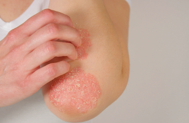 How Red Light Therapy Helps with Eczema, Psoriasis, and Shingles