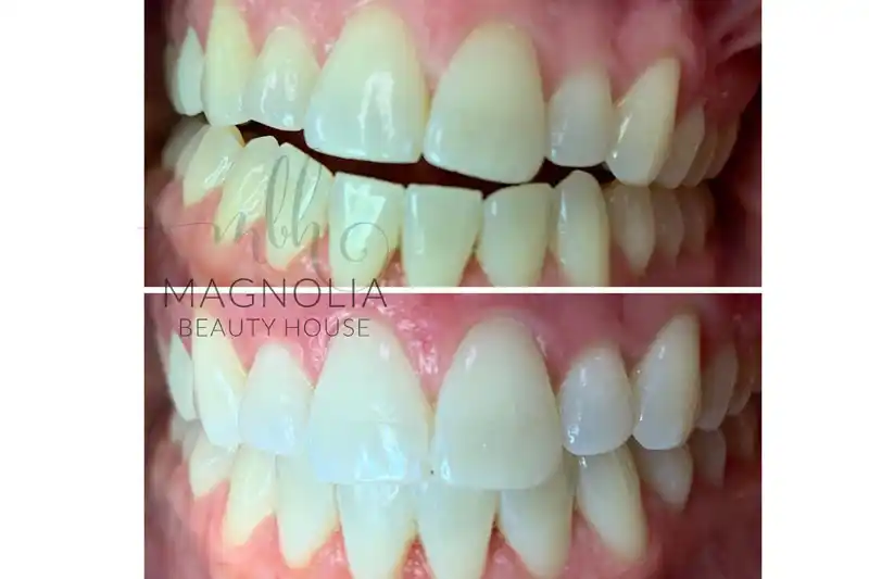 Behind the Scenes of Teeth Whitening with Magnolia Beauty House